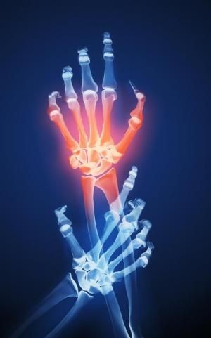 Rheumatoid Arthiritis powder(100gm)